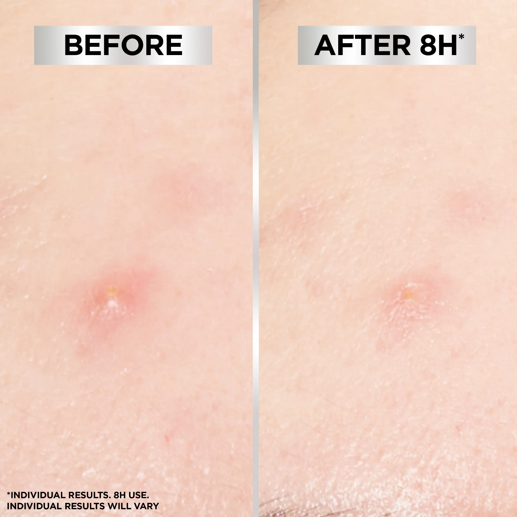Garnier Pure Active 8 Hour Invisible Blemish Hydrocolloid Patches x22 - Image 5