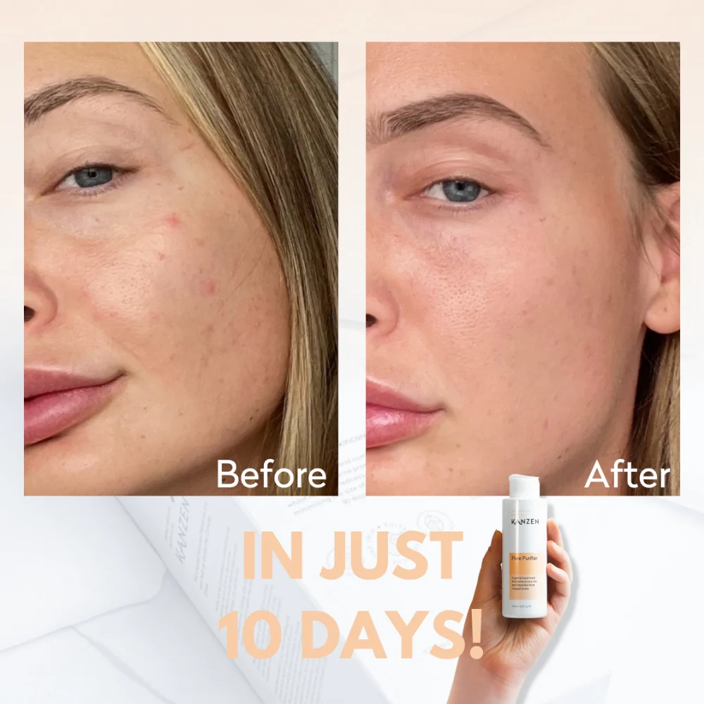 Kanzen Derma Pore Purifier 125ml - Image 3