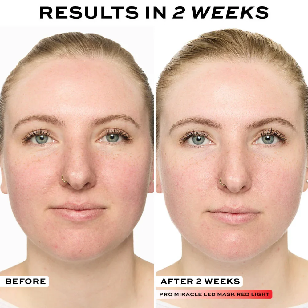Makeup Revolution Revolution Pro Miracle LED Face Mask - Image 4