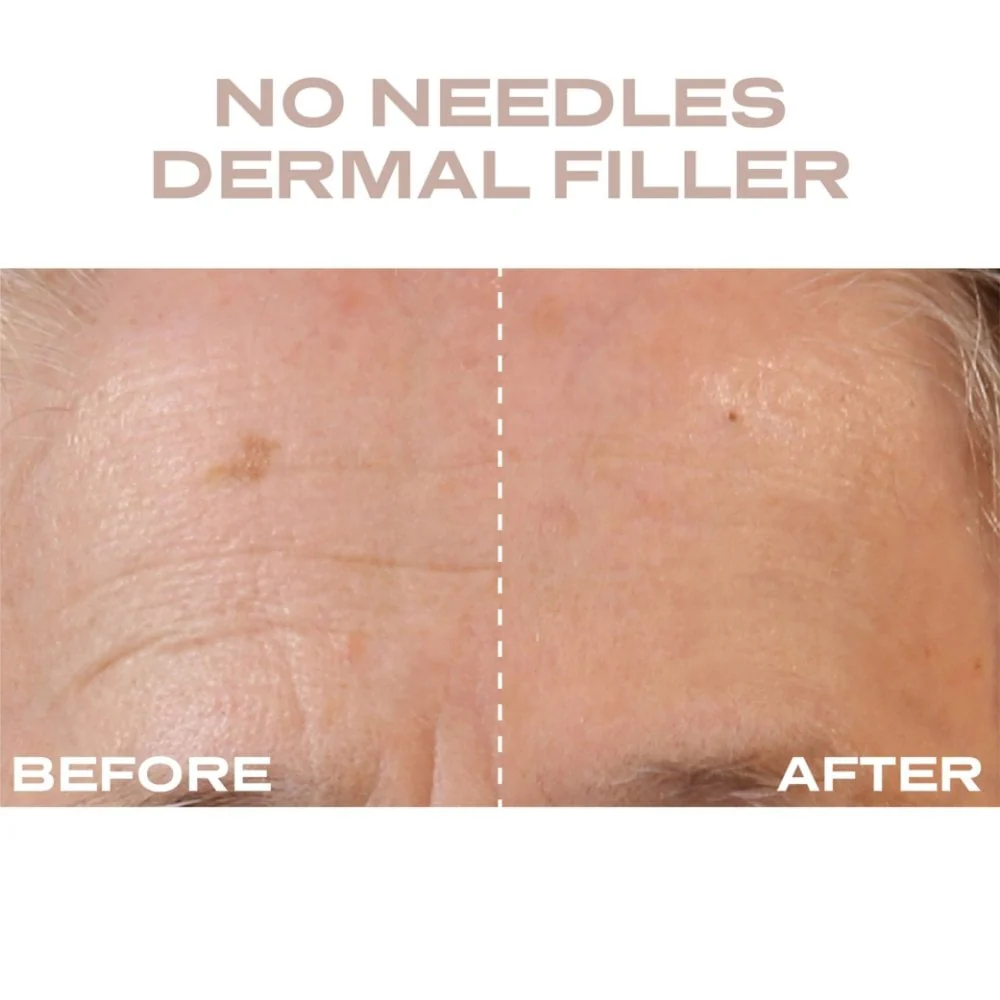 Plump It No Needles Derma Filler Pods Starter Kit 15 x 10ml - Image 4