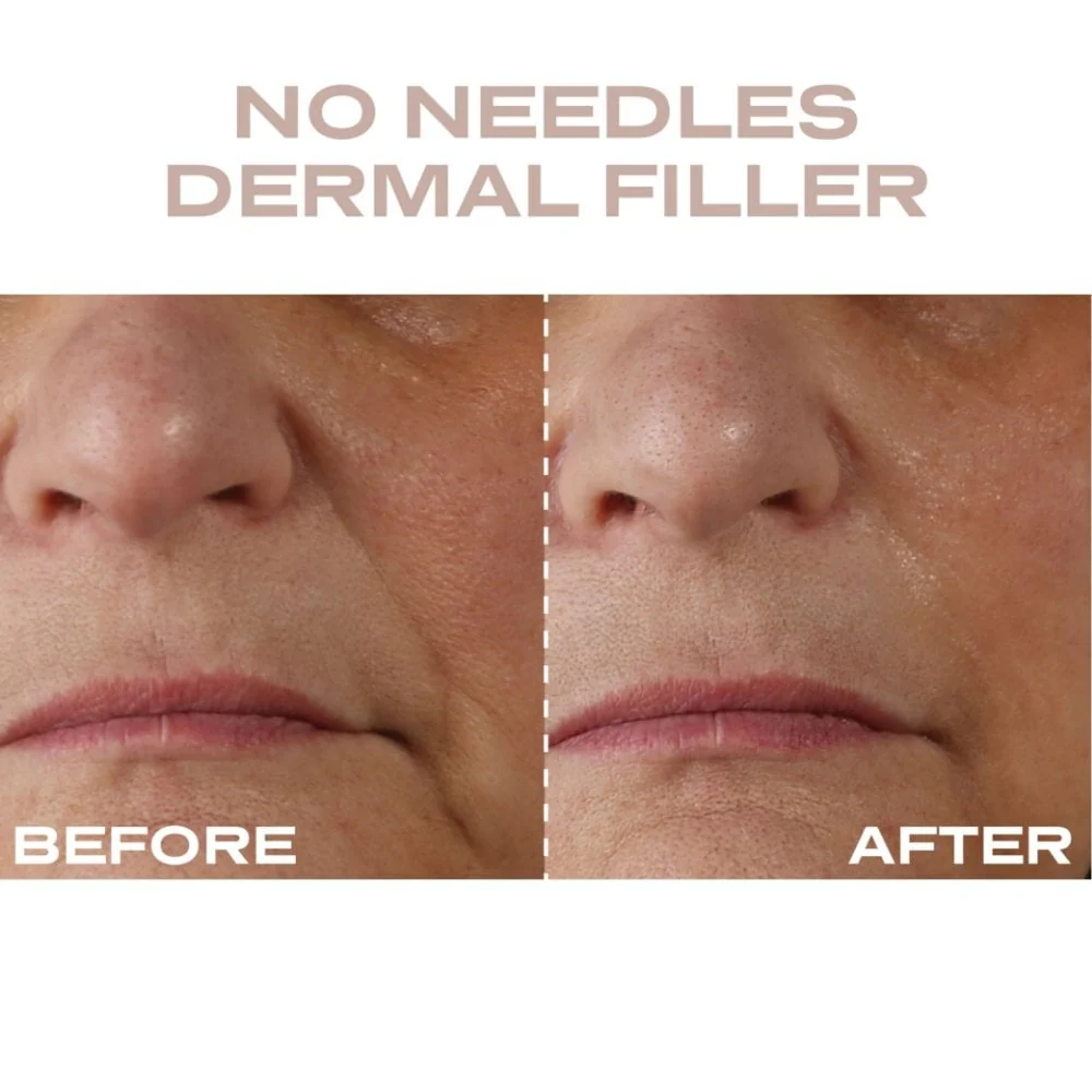 Plump It No Needles Derma Filler Pods Starter Kit 15 x 10ml - Image 5