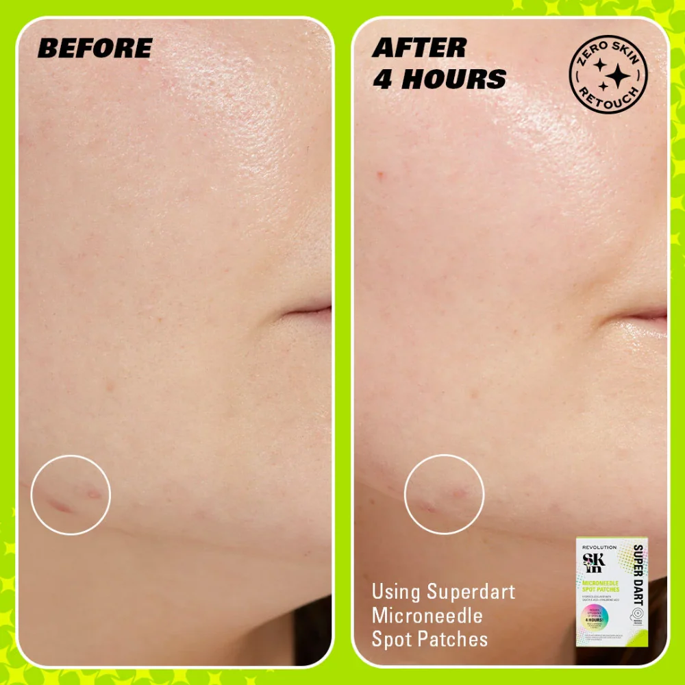 Revolution Skincare Super Dart Microneedle Salicylic Acid Hydrocolloid Spot Patches x9 - Image 3