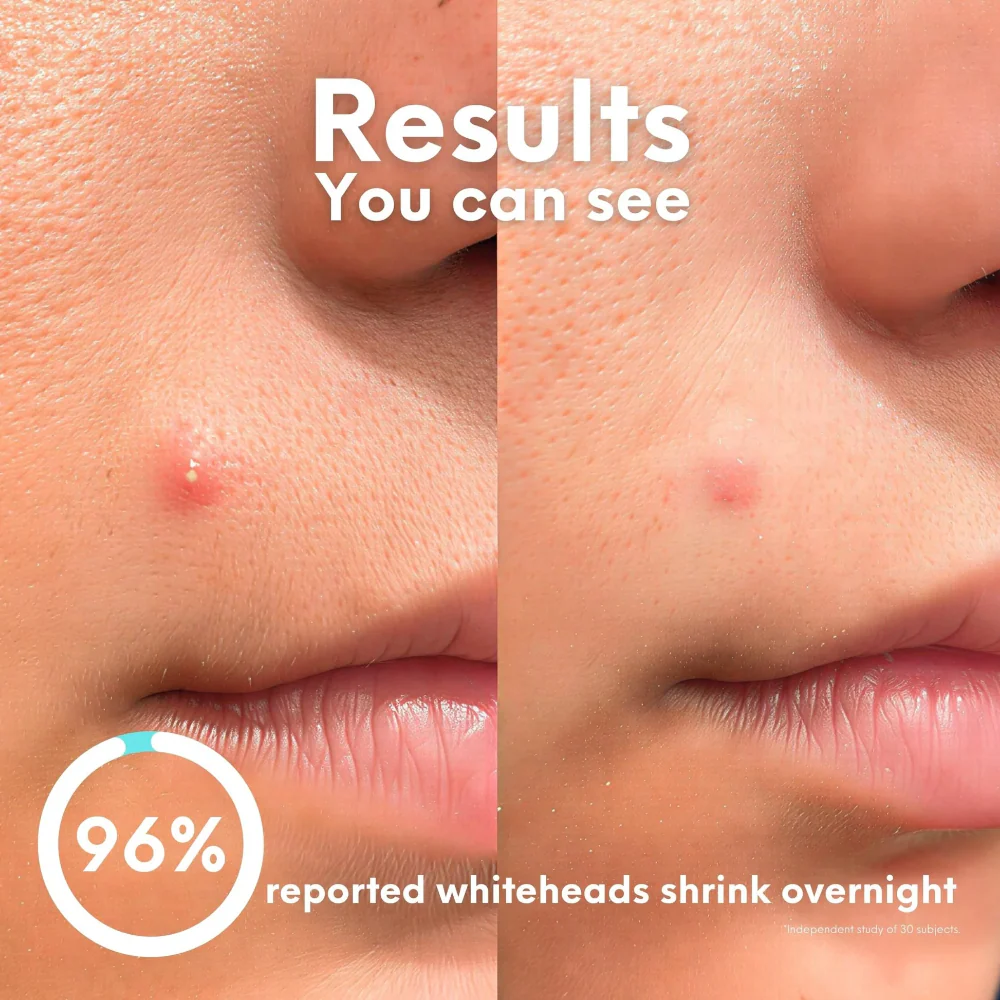 Skin Choice Breakout Classic Acne Spot Pimple Patches x75 - Image 10