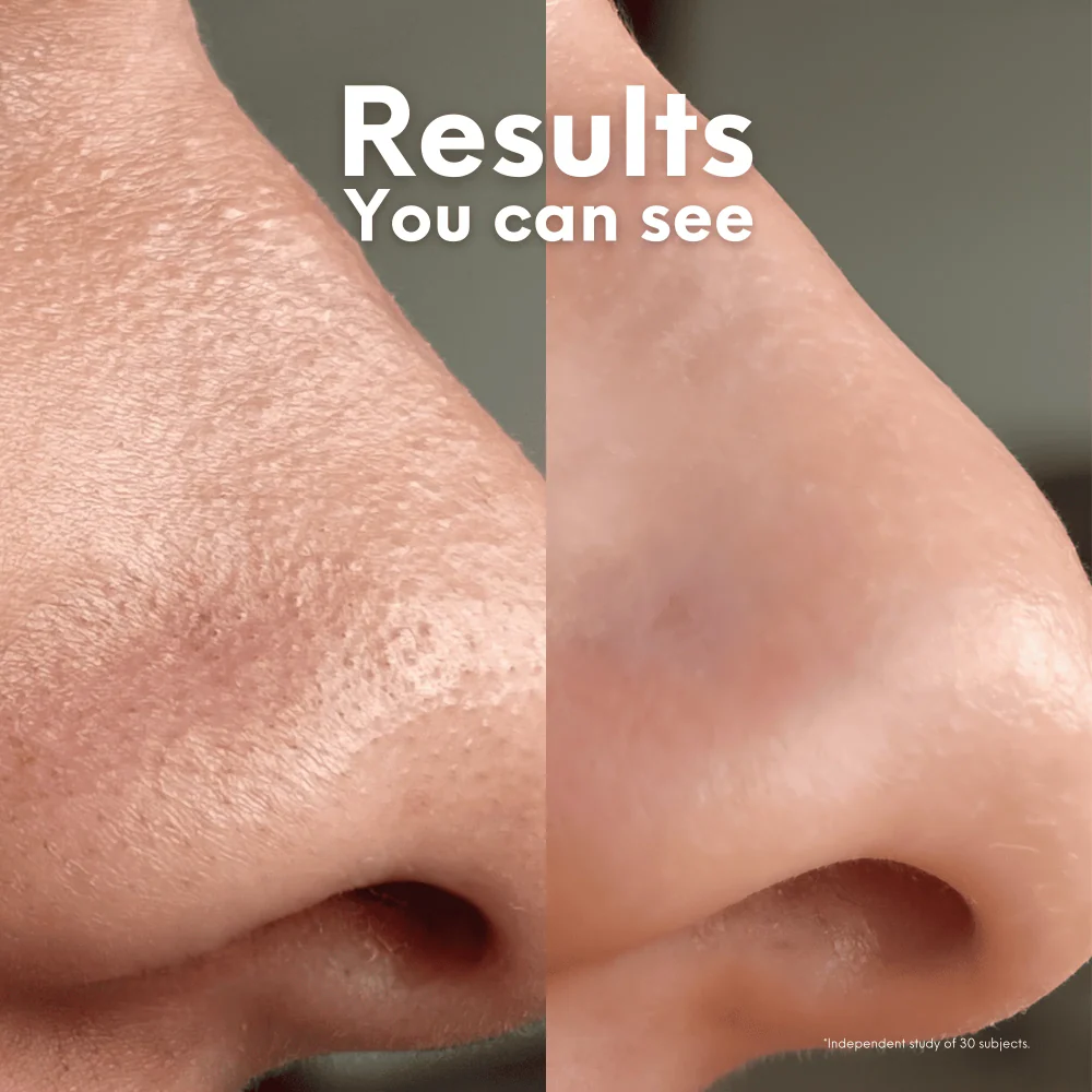 Skin Choice Breakout Classic Nose Hydrocolloid Pore Patches x10 - Image 5