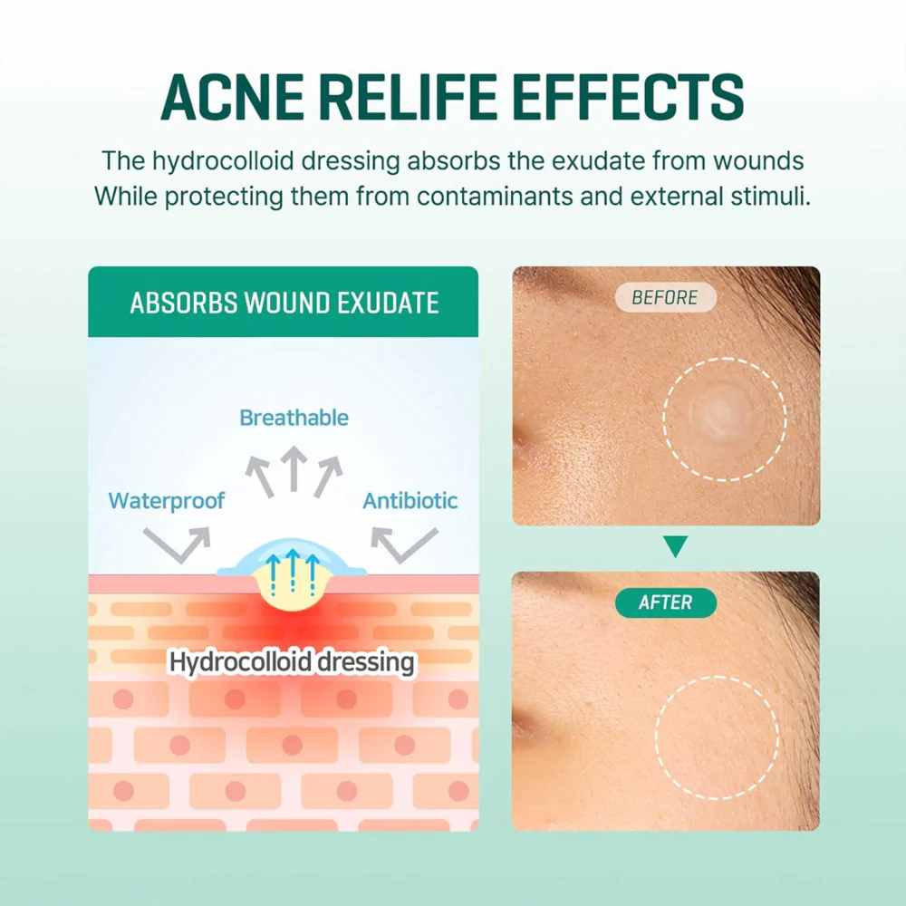 Some By Mi 30 Days Miracle Intensive Clear Spot Patches x18 - Image 4
