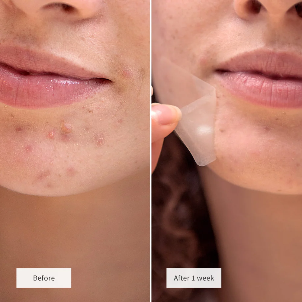 Vue Hydrocolloid Chin Patches x8 - Image 3