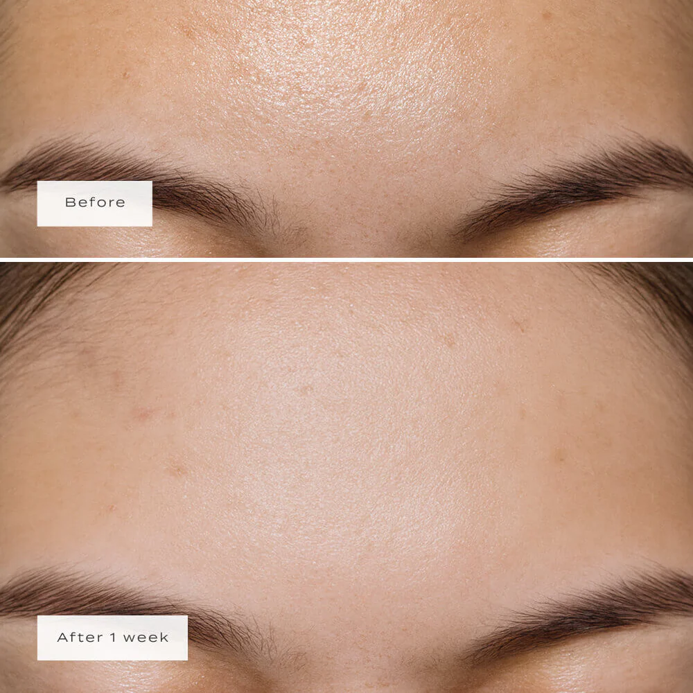 Vue Hydrocolloid Forehead Patches x5 - Image 4