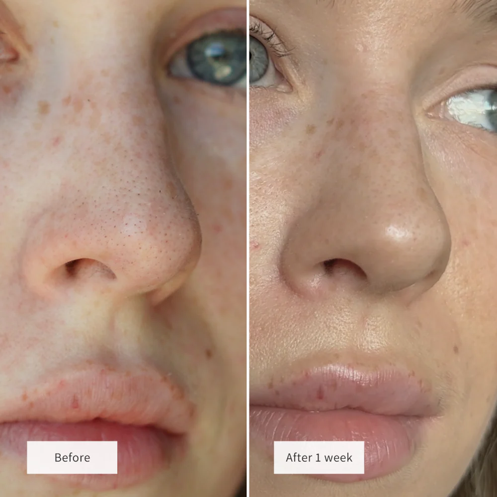 Vue Hydrocolloid Nose Patches x8 - Image 4