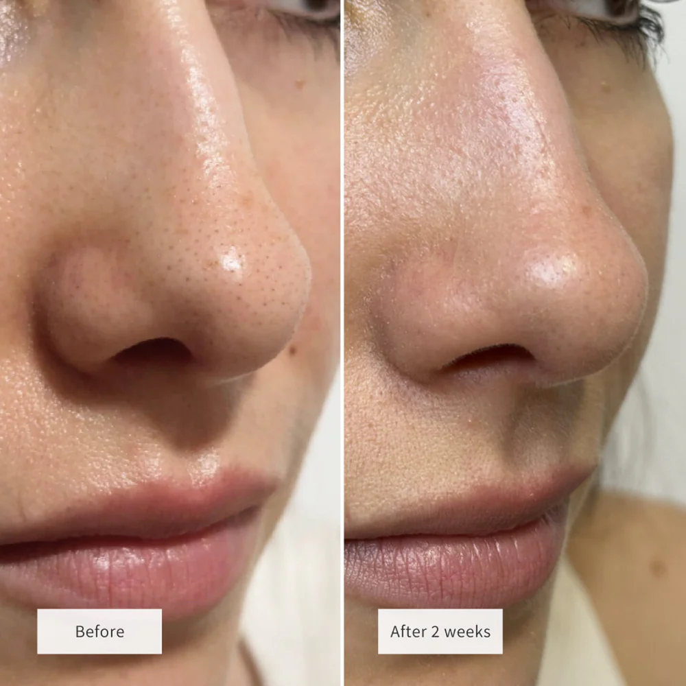 Vue Hydrocolloid Nose Patches x8 - Image 5