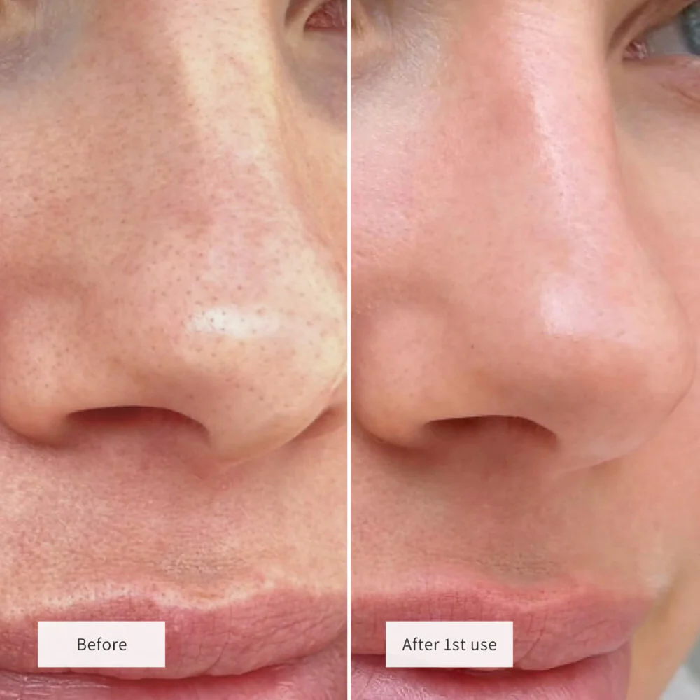 Vue Hydrocolloid Nose Patches x8 - Image 6